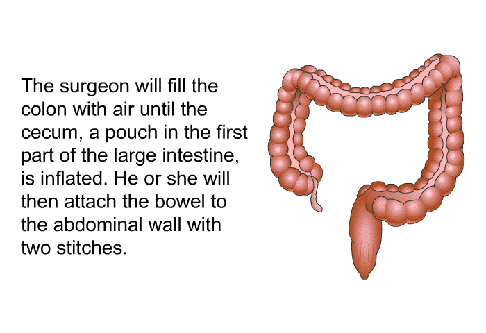 The surgeon will fill the colon with air until the cecum, a pouch in the first part of the large intestine, is inflated. He or she will then attach the bowel to the abdominal wall with two stitches.