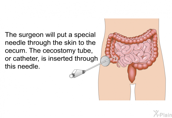The surgeon will put a special needle through the skin to the cecum. The cecostomy tube, or catheter, is inserted through this needle.