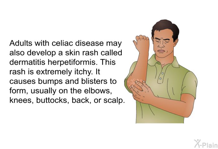 Adults with celiac disease may also develop a skin rash called dermatitis herpetiformis. This rash is extremely itchy. It causes bumps and blisters to form, usually on the elbows, knees, buttocks, back, or scalp.