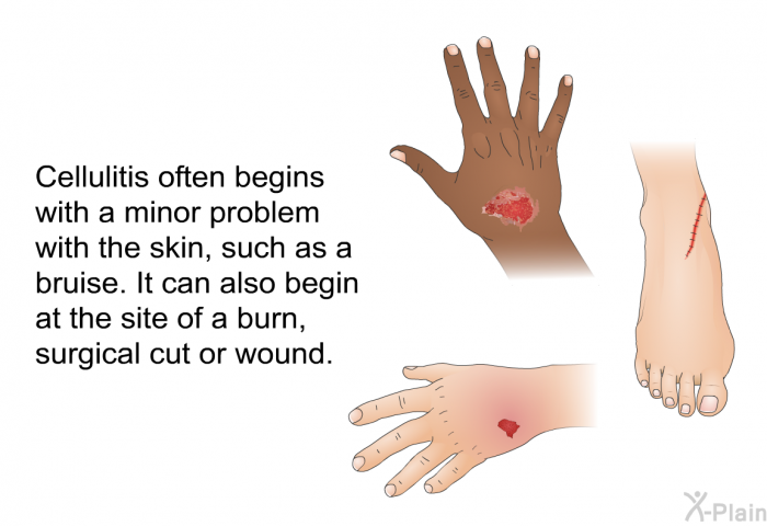 Cellulitis often begins with a minor problem with the skin, such as a bruise. It can also begin at the site of a burn, surgical cut or wound.