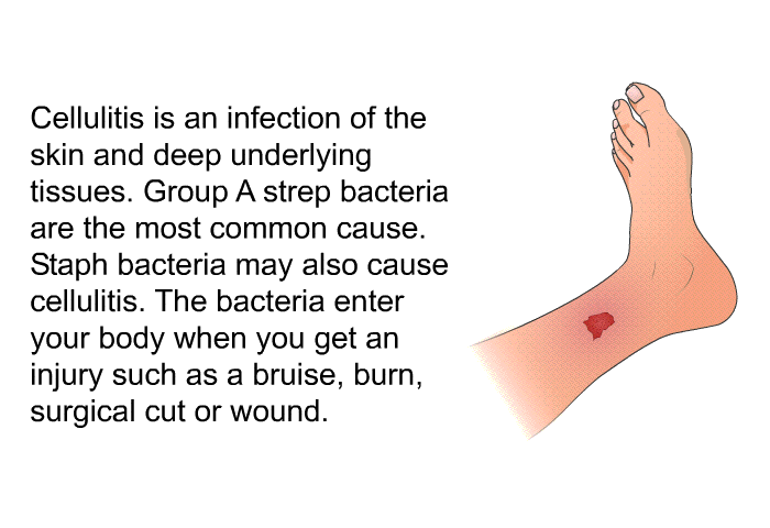 Cellulitis is an infection of the skin and deep underlying tissues. Group A strep bacteria are the most common cause. Staph bacteria may also cause cellulitis. The bacteria enter your body when you get an injury such as a bruise, burn, surgical cut or wound.