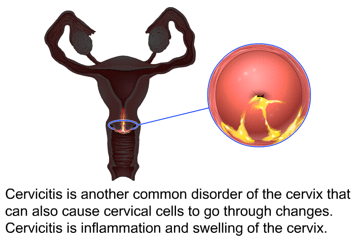 Cervicitis is another common disorder of the cervix that can also cause cervical cells to go through changes. Cervicitis is inflammation and swelling of the cervix.