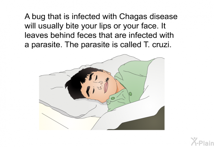 A bug that is infected with Chagas disease will usually bite your lips or your face. It leaves behind feces that are infected with a parasite. The parasite is called T. cruzi.