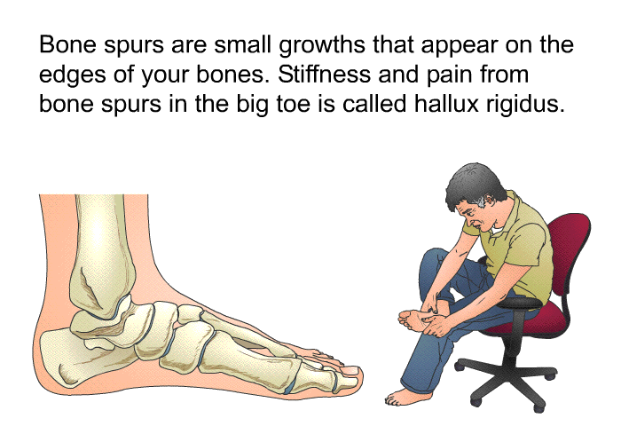 Bone spurs are small growths that appear on the edges of your bones. Stiffness and pain from bone spurs in the big toe is called hallux rigidus.
