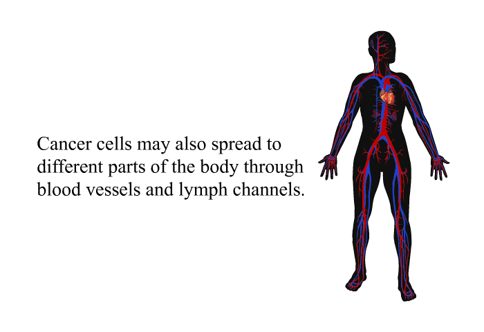 Cancer cells may also spread to different parts of the body through blood vessels and lymph channels.