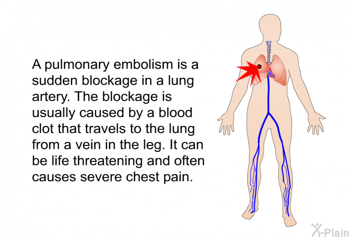 A pulmonary embolism is a sudden blockage in a lung artery. The blockage is usually caused by a blood clot that travels to the lung from a vein in the leg. It can be life threatening and often causes severe chest pain.