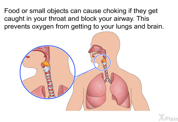 Food or small objects can cause choking if they get caught in your throat and block your airway. This prevents oxygen from getting to your lungs and brain.