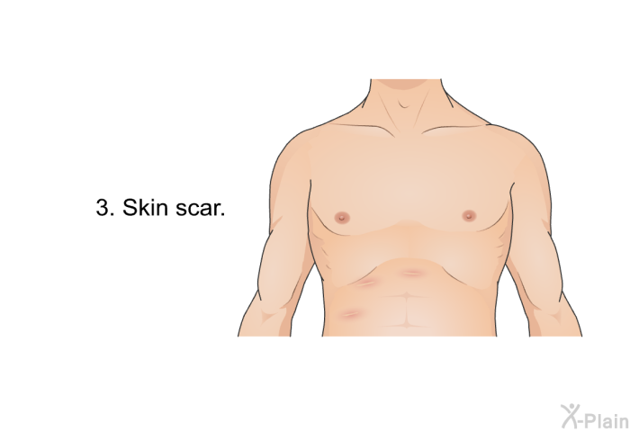 Skin scar.
