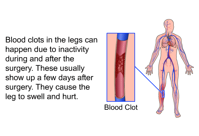 Blood clots in the legs can happen due to inactivity during and after the surgery. These usually show up a few days after surgery. They cause the leg to swell and hurt.