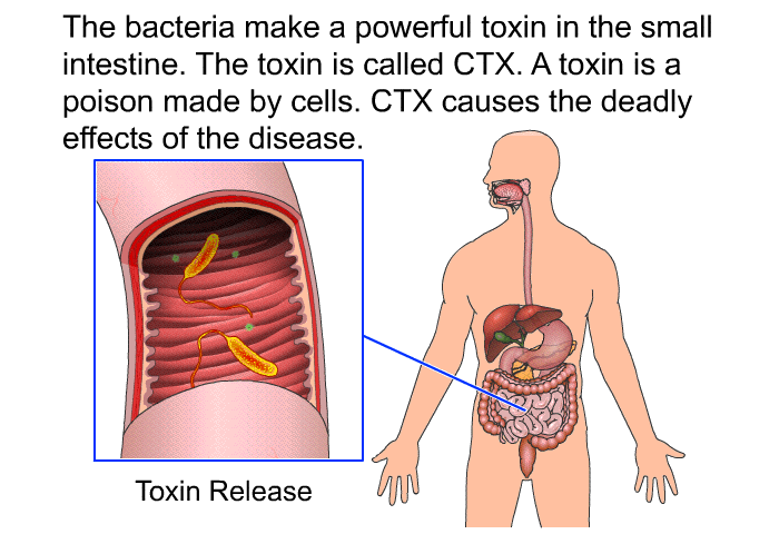 The bacteria make a powerful toxin in the small intestine. The toxin is called CTX. A toxin is a poison made by cells. CTX causes the deadly effects of the disease.