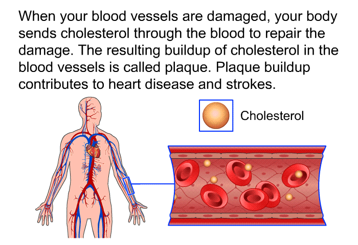 When your blood vessels are damaged, your body sends cholesterol through the blood to repair the damage. The resulting buildup of cholesterol in the blood vessels is called plaque. Plaque buildup contributes to heart disease and strokes.
