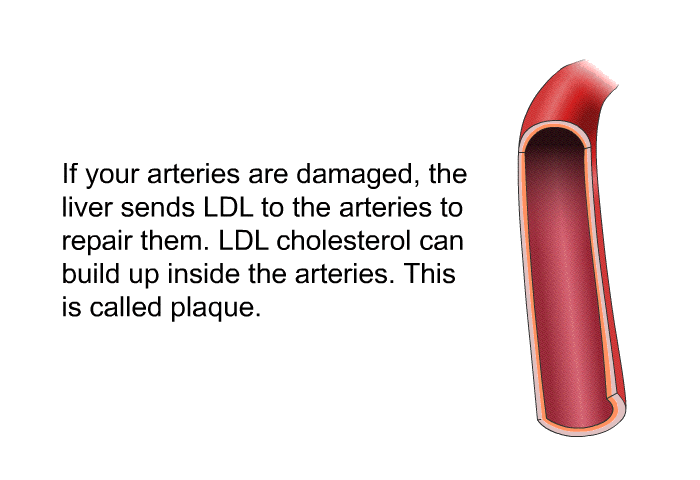 If your arteries are damaged, the liver sends LDL to the arteries to repair them. LDL cholesterol can build up inside the arteries. This is called plaque.