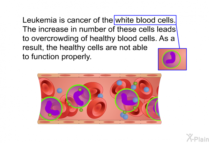 Leukemia is cancer of the white blood cells. The increase in number of these cells leads to overcrowding of healthy blood cells. As a result, the healthy cells are not able to function properly.