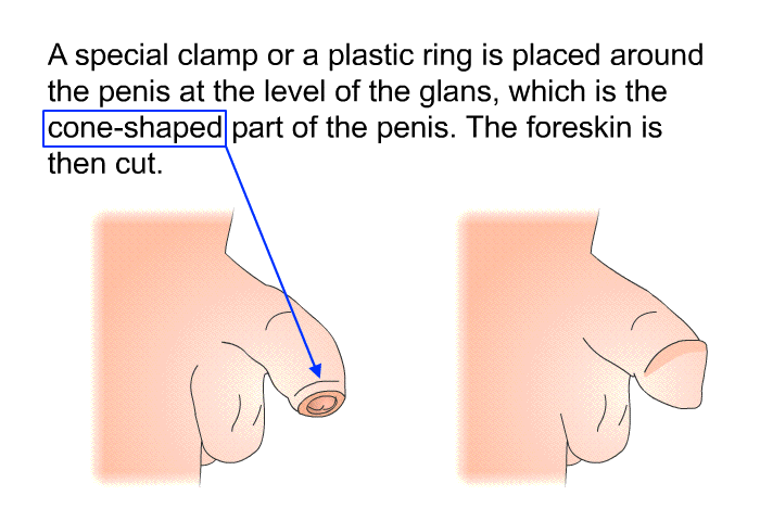 A special clamp or a plastic ring is placed around the penis at the level of the glans, which is the cone-shaped part of the penis. The foreskin is then cut.