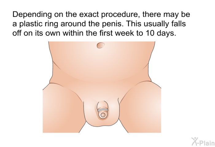 Depending on the exact procedure, there may be a plastic ring around the penis. This usually falls off on its own within the first week to 10 days.