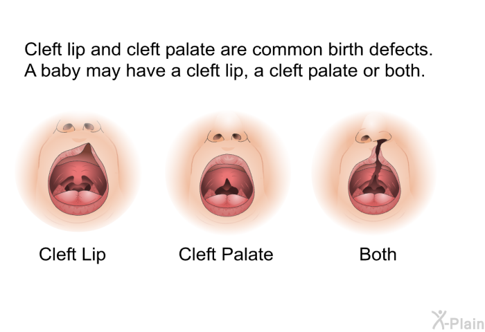 Cleft lip and cleft palate are common birth defects. A baby may have a cleft lip, a cleft palate or both.