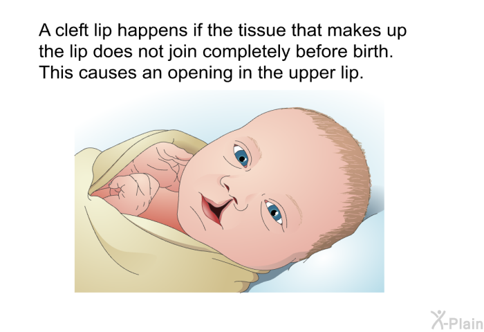 A cleft lip happens if the tissue that makes up the lip does not join completely before birth. This causes an opening in the upper lip.