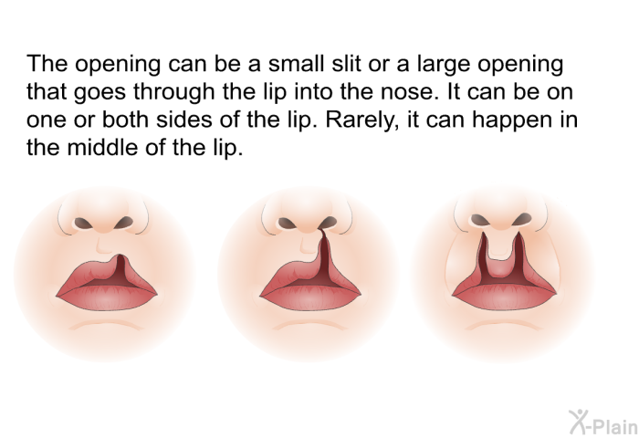 The opening can be a small slit or a large opening that goes through the lip into the nose. It can be on one or both sides of the lip. Rarely, it can happen in the middle of the lip.