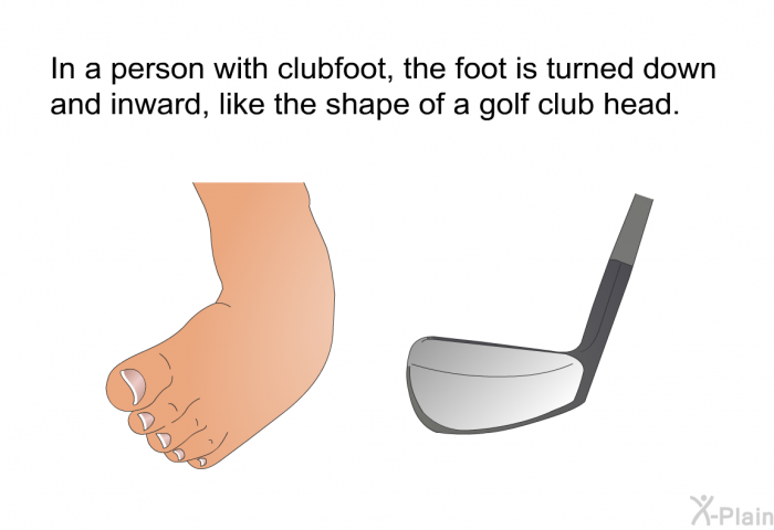 In a person with clubfoot, the foot is turned down and inward, like the shape of a golf club head.