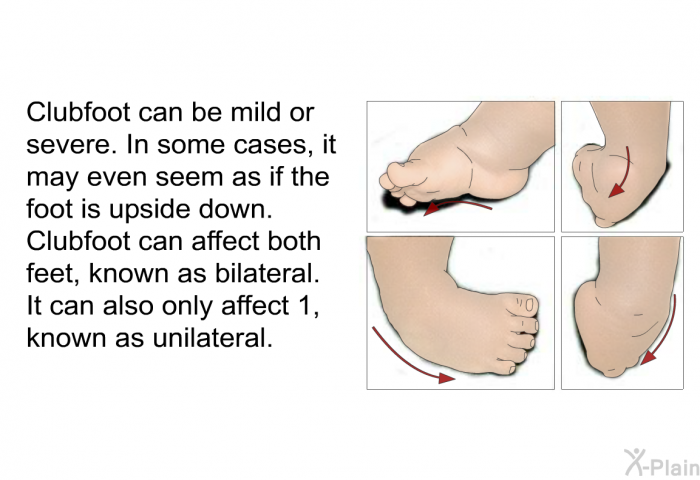 Clubfoot can be mild or severe. In some cases, it may even seem as if the foot is upside down. Clubfoot can affect both feet, known as bilateral. It can also only affect 1, known as unilateral.