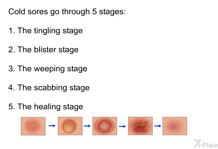Cold sores go through 5 stages:  The tingling stage The blister stage The weeping stage The scabbing stage The healing stage