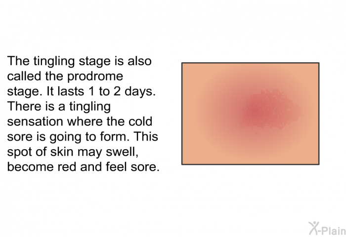 The tingling stage is also called the prodrome stage. It lasts 1 to 2 days. There is a tingling sensation where the cold sore is going to form. This spot of skin may swell, become red and feel sore.
