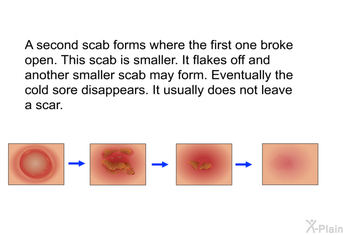 A second scab forms where the first one broke open. This scab is smaller. It flakes off and another smaller scab may form. Eventually the cold sore disappears. It usually does not leave a scar.