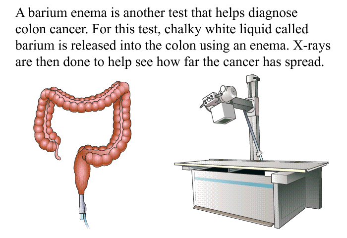 A barium enema is another test that helps diagnose colon cancer. For this test, chalky white liquid called barium is released into the colon using an enema. X-rays are then done to help see how far the cancer has spread.