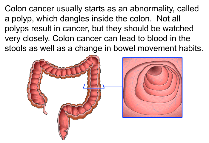 Colon cancer usually starts as an abnormality, called a polyp, which dangles inside the colon. Not all polyps result in cancer, but they should be watched very closely. Colon cancer can lead to blood in the stools as well as a change in bowel movement habits.