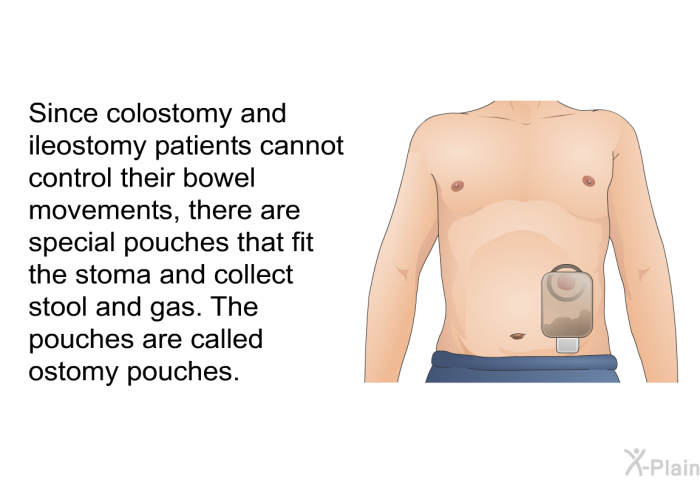 Since colostomy and ileostomy patients cannot control their bowel movements, there are special pouches that fit the stoma and collect stool and gas. The pouches are called ostomy pouches.