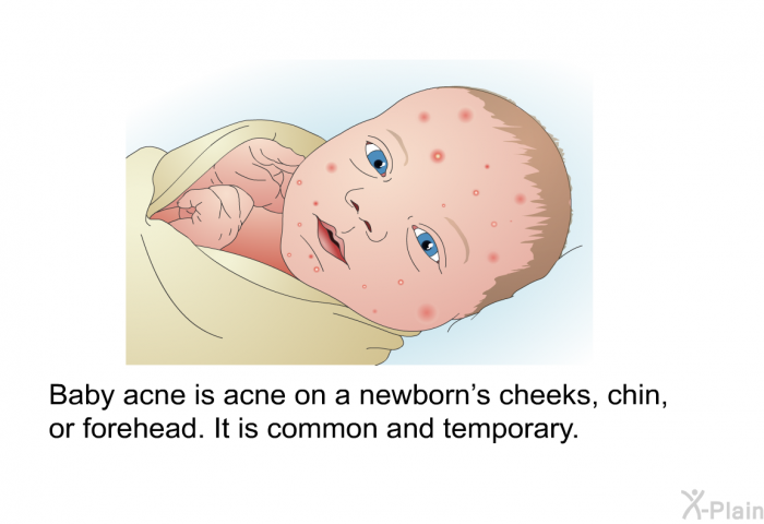 Baby acne is acne on a newborn's cheeks, chin, or forehead. It is common and temporary.