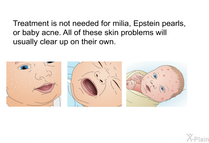 Treatment is not needed for milia, Epstein pearls, or baby acne. All of these skin problems will usually clear up on their own.