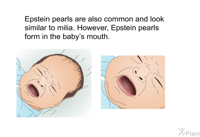 Epstein pearls are also common and look similar to milia. However, Epstein pearls form in the baby's mouth.