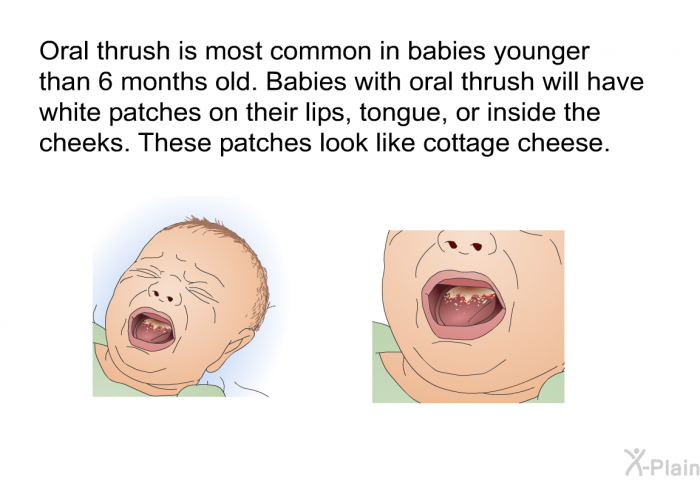 Oral thrush is most common in babies younger than 6 months old. Babies with oral thrush will have white patches on their lips, tongue, or inside the cheeks. These patches look like cottage cheese.