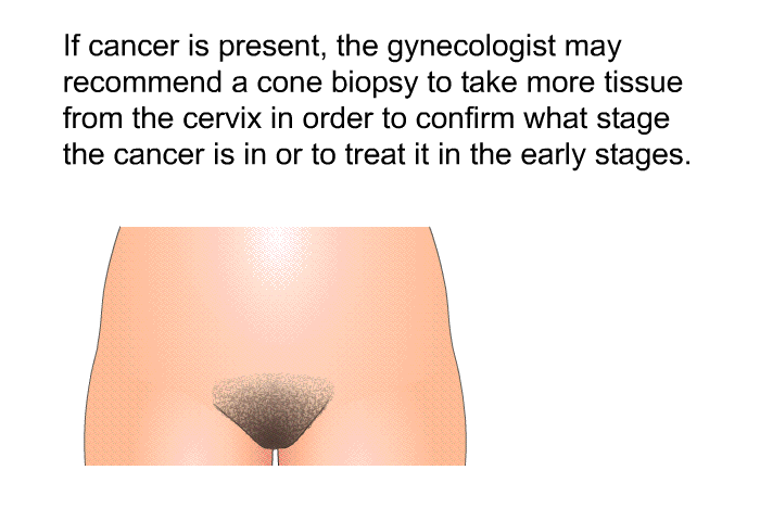 If cancer is present, the gynecologist may recommend a cone biopsy to take more tissue from the cervix in order to confirm what stage the cancer is in or to treat it in the early stages.