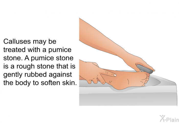 Calluses may be treated with a pumice stone. A pumice stone is a rough stone that is gently rubbed against the body to soften skin.