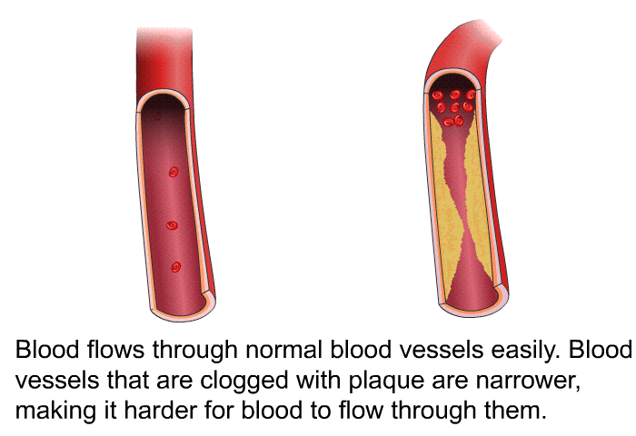 Blood flows through normal blood vessels easily. Blood vessels that are clogged with plaque are narrower, making it harder for blood to flow through them.
