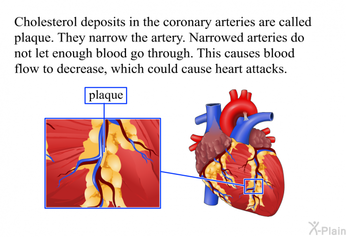 Cholesterol deposits in the coronary arteries are called plaque. They narrow the artery. Narrowed arteries do not let enough blood go through. This causes blood flow to decrease, which could cause heart attacks.