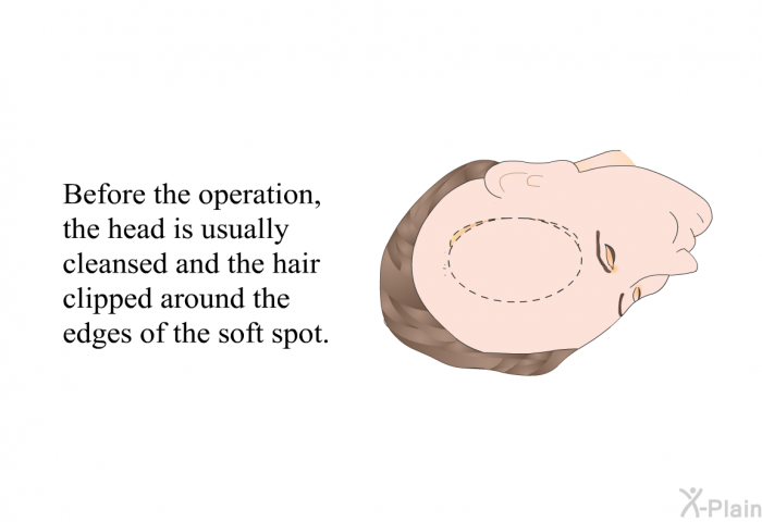 Before the operation, the head is usually cleansed and the hair clipped around the edges of the soft spot.