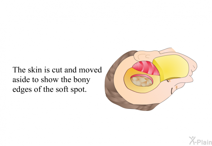 The skin is cut and moved aside to show the bony edges of the soft spot.