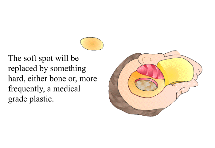 The soft spot will be replaced by something hard, either bone or, more frequently, a medical grade plastic.