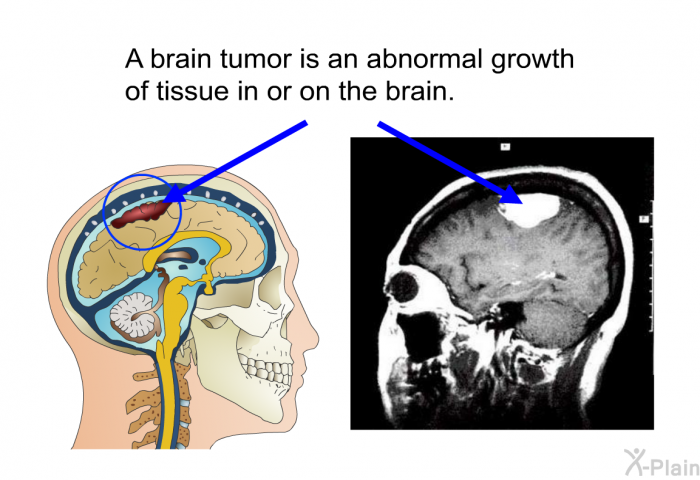 A brain tumor is an abnormal growth of tissue in or on the brain.