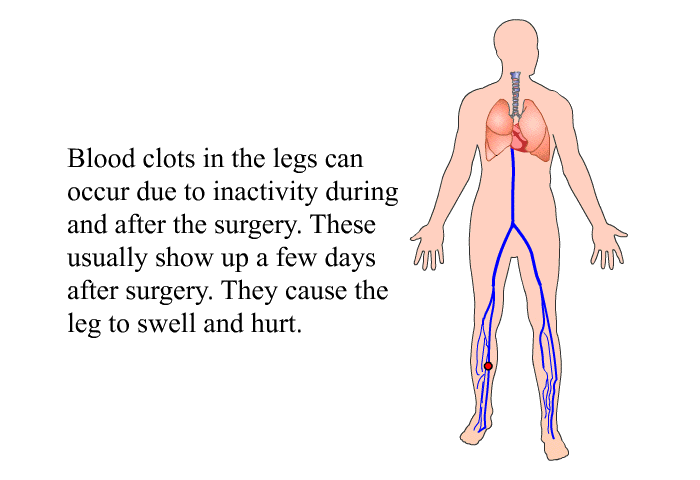 Blood clots in the legs can occur due to inactivity during and after the surgery. These usually show up a few days after surgery. They cause the leg to swell and hurt.