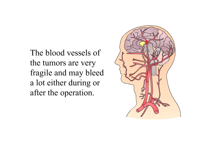 The blood vessels of the tumors are very fragile and may bleed a lot either during or after the operation.