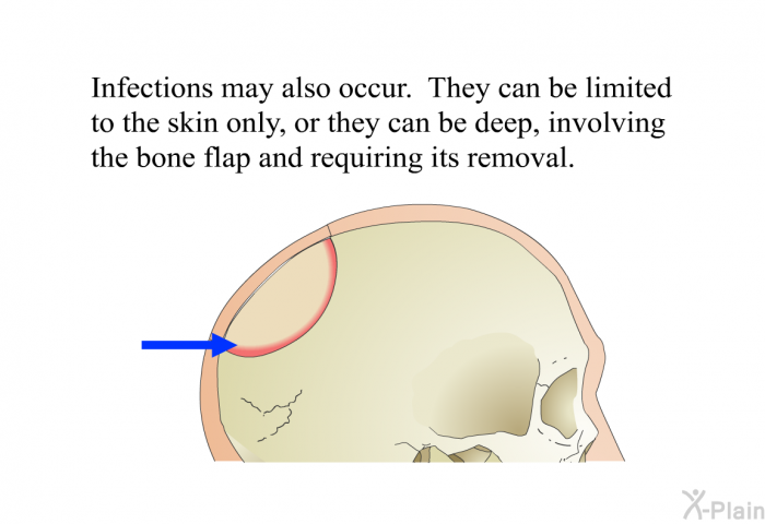 Infections may also occur. They can be limited to the skin only, or they can be deep, involving the bone flap and requiring its removal.