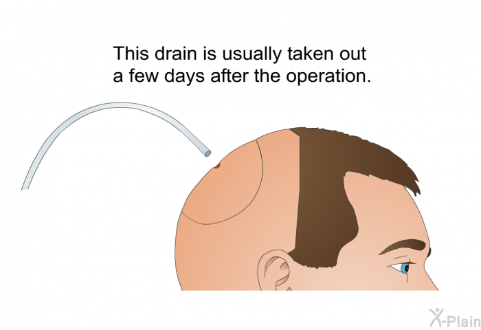 This drain is usually taken out a few days after the operation.