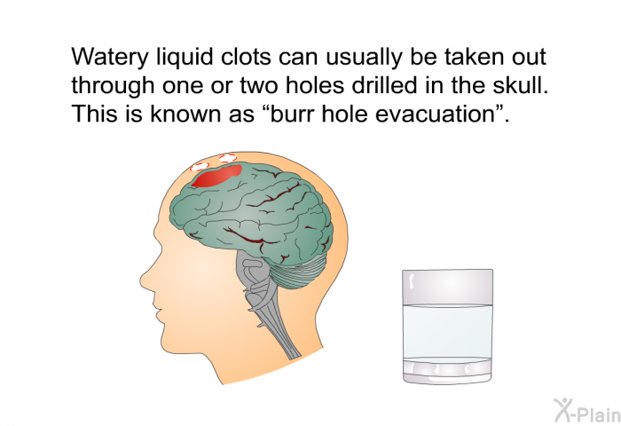 Watery liquid clots can usually be taken out through one or two holes drilled in the skull. This is known as &ldquo;burr hole evacuation&rdquo;.