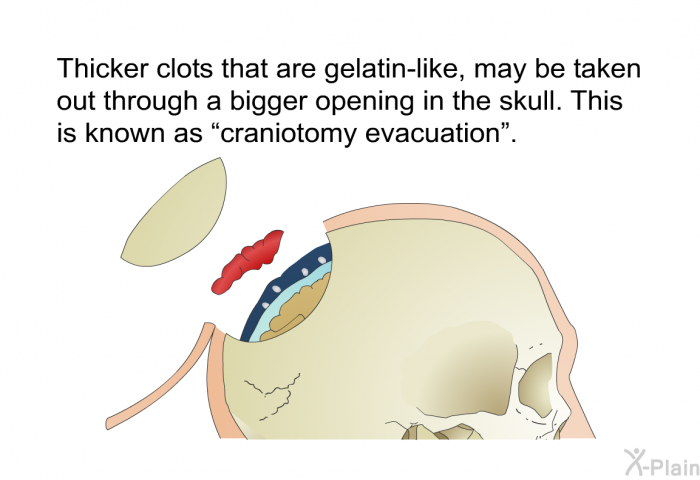 Thicker clots that are gelatin-like, may be taken out through a bigger opening in the skull. This is known as &ldquo;craniotomy evacuation&rdquo;.