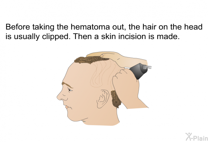 Before taking the hematoma out, the hair on the head is usually clipped. Then a skin incision is made.