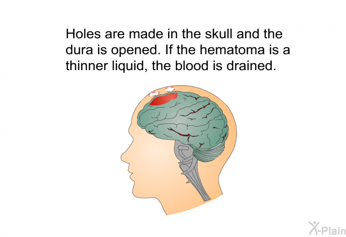 Holes are made in the skull and the dura is opened. If the hematoma is a thinner liquid, the blood is drained.